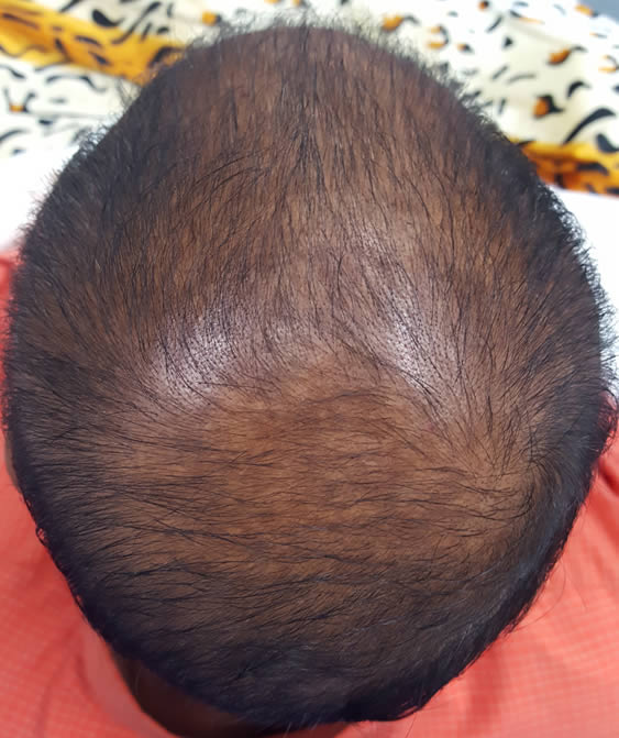 preeminent-hair-regeneration-after-one-treatment-55-year-old-man-w